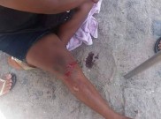Acidente na Massagueira em Marechal Deodoro deixa garupa de motociclista ferida