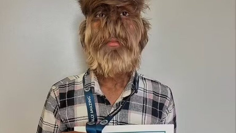 ‘Síndrome de lobisomem’: jovem quebra recorde de ‘rosto mais peludo do mundo’; entenda